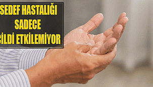 Sedef Hastalığı Sadece Cildi Etkilemiyor